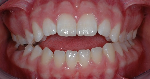 Open Bite